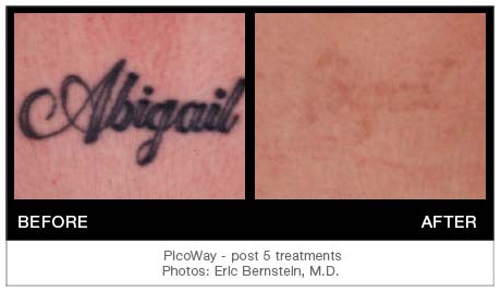 Picoway TattooResults1 | PicoWay Tattoo Removal