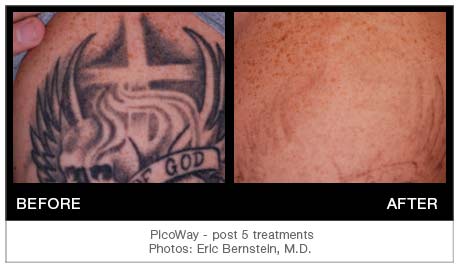 PicowayTattooResults2 | PicoWay Tattoo Removal