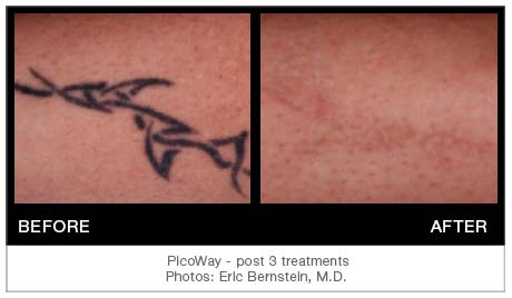 PicowayTattooResults3 | PicoWay Tattoo Removal