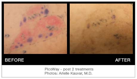 PicowayTattooResults4 | PicoWay Tattoo Removal